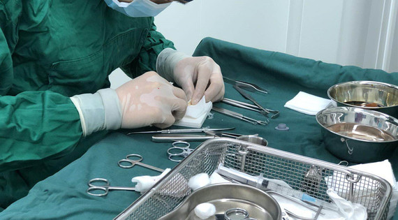 术后注意事项1,术后当天:术后,鼻背部会有夹板固定,有切口的鼻孔填塞