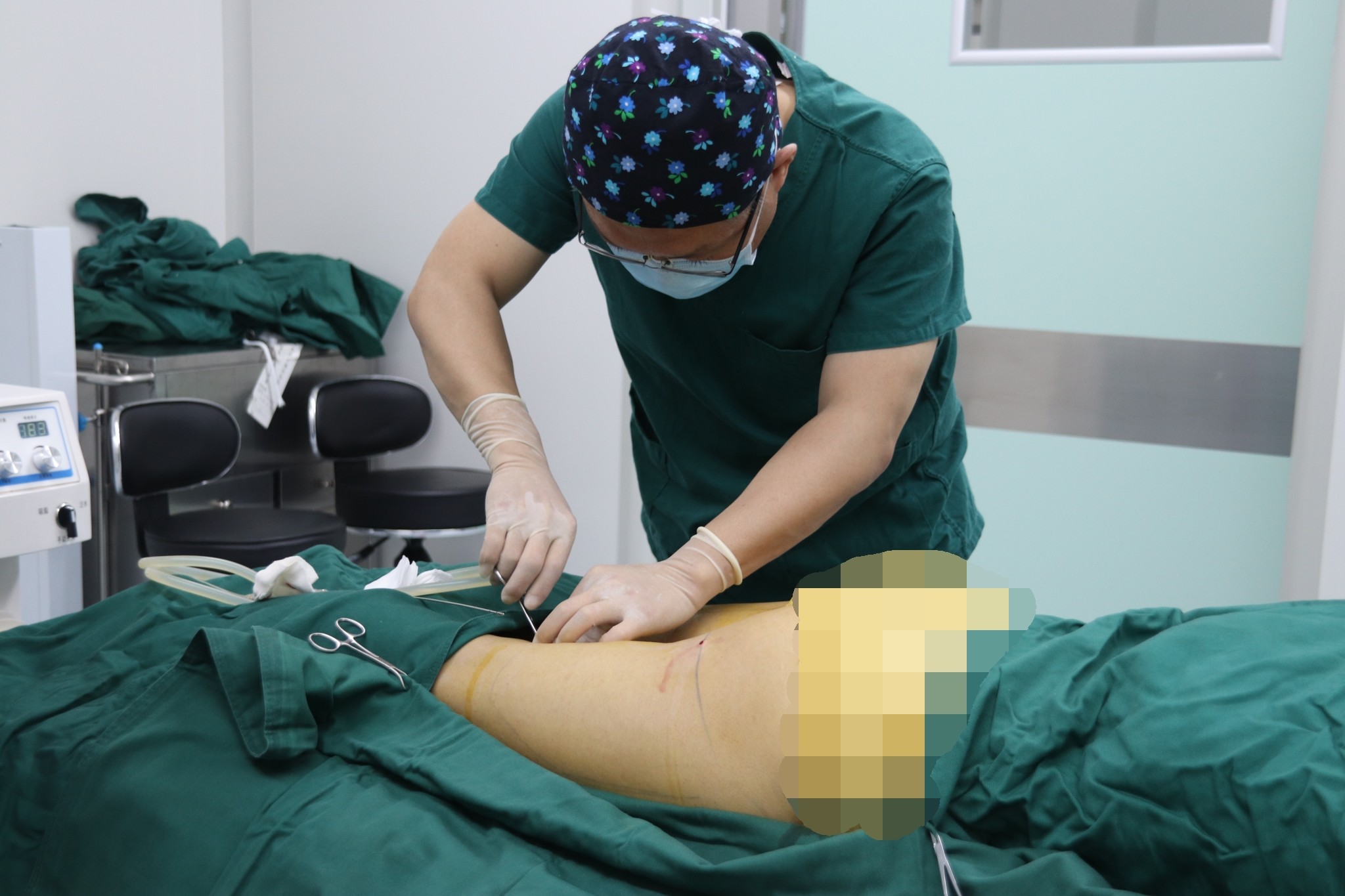 5,将配好的肿胀液由医疗器械注入大腿前侧和外侧的皮下脂肪层,至皮肤