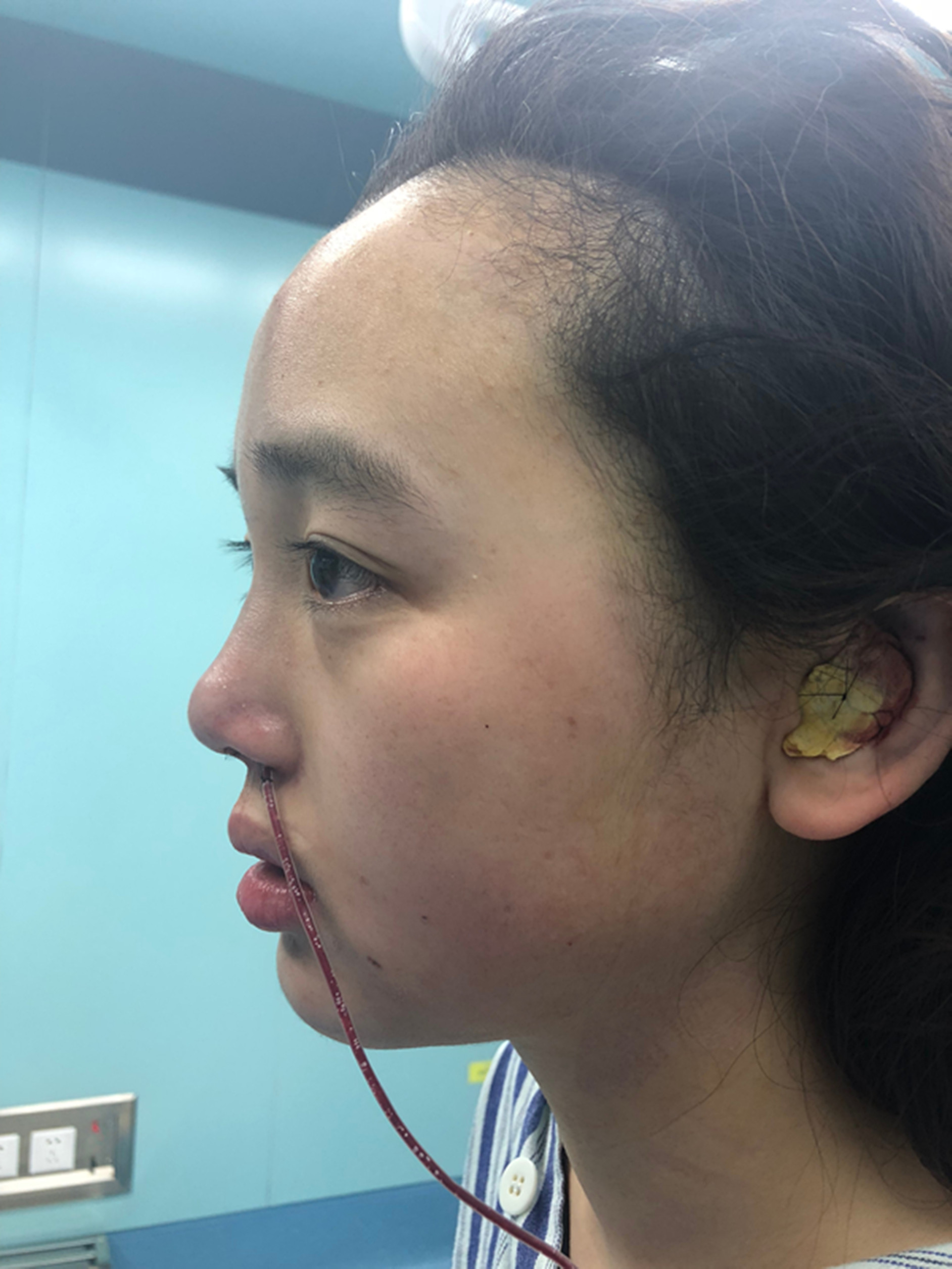 7,鼻部加压塑型版固定包扎.