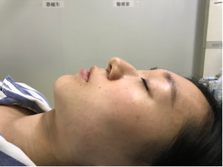 手术时长2小时术前照片术后照片报告亮点颜值爆棚主诉_圈子-新氧美容