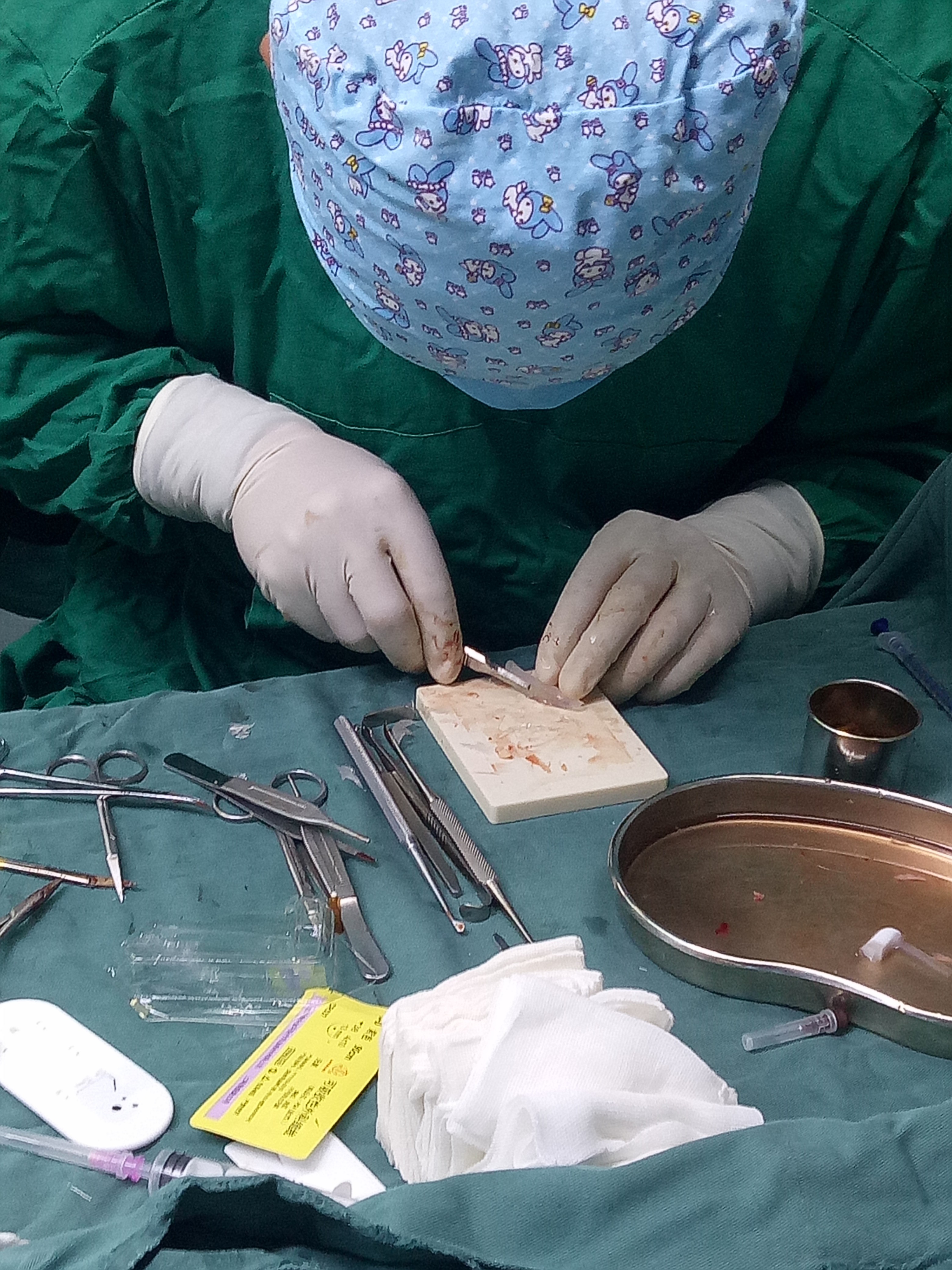 鼻整形剪经鼻小柱切口沿大翼软骨软骨膜表面剥离,暴露大翼软骨内侧脚