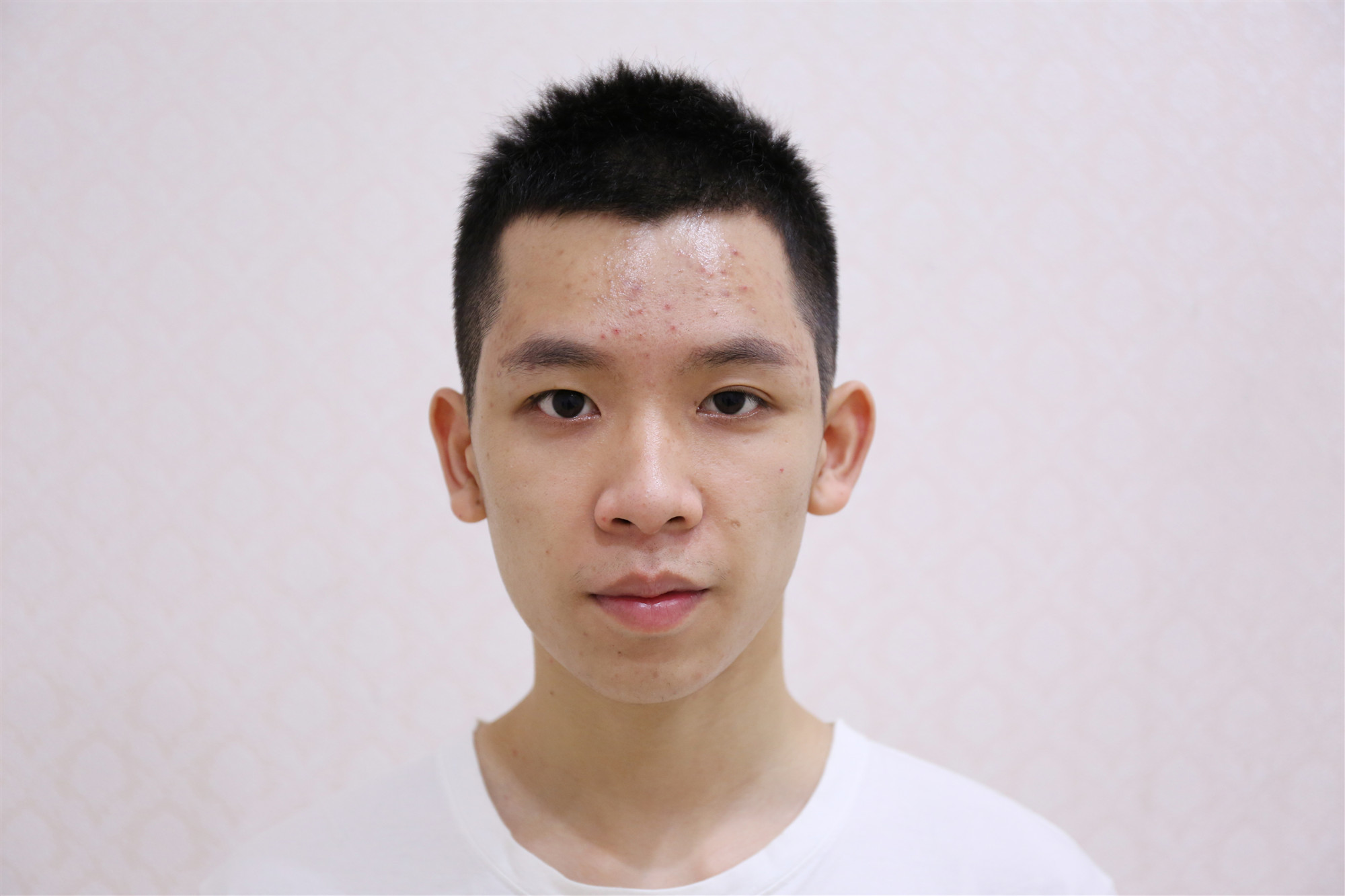 分析了求美者的面部情况,鼻背宽,鼻头大,鼻尖圆钝,鼻翼稍微有点肥厚