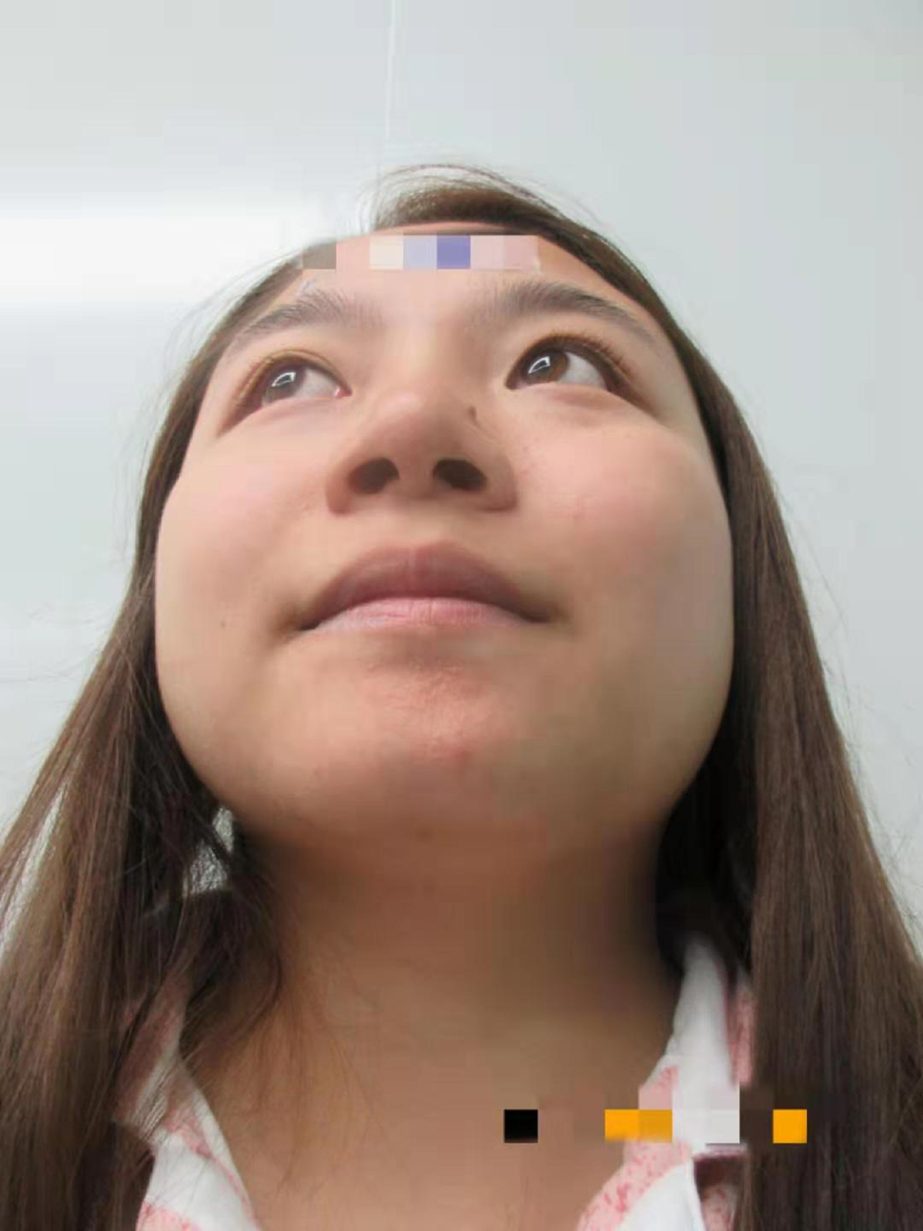 垫假体延长下巴  求美者情况分析  检查数据 1,鼻额角:140° 2,鼻小柱