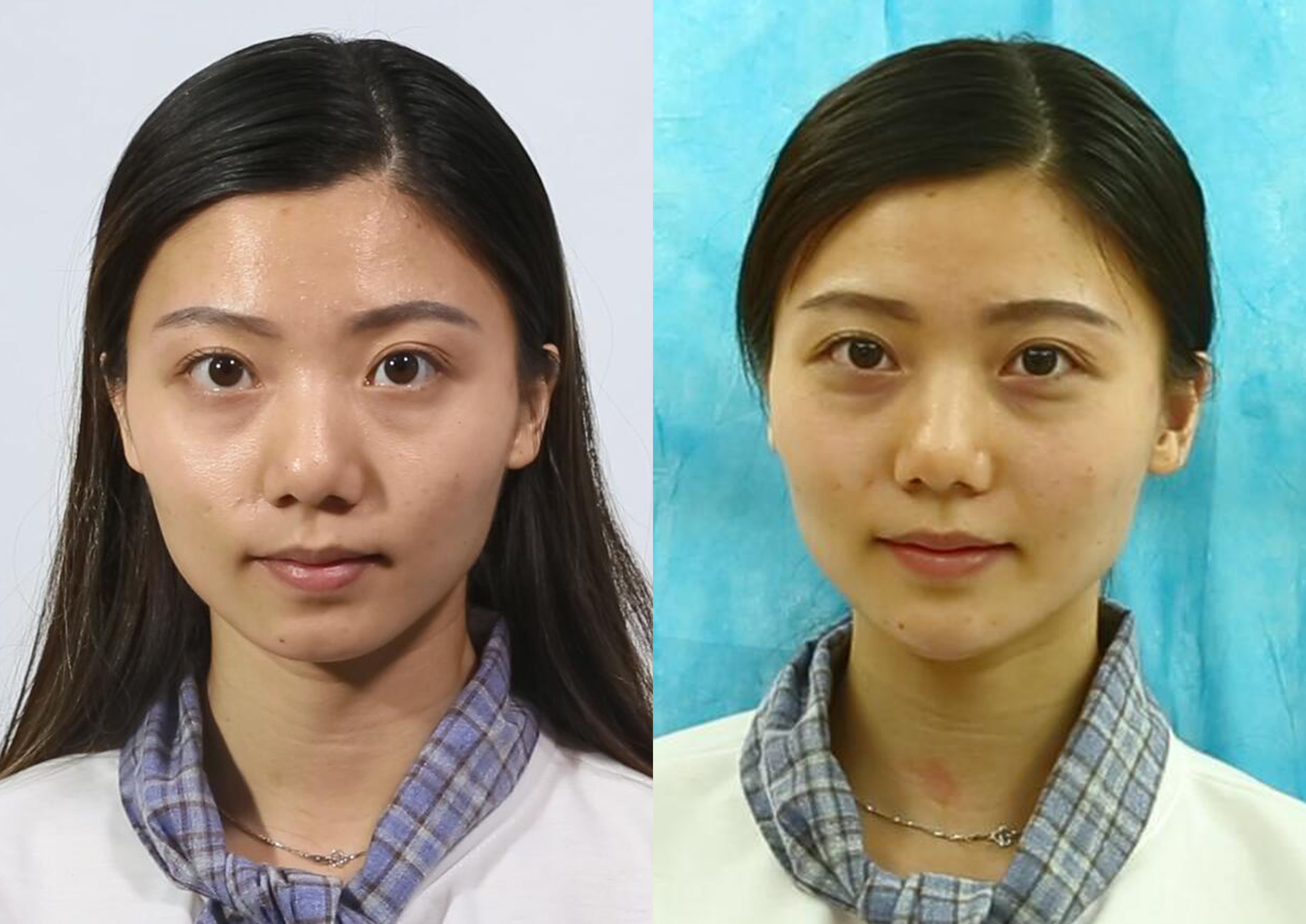 术前术后对比照