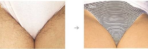 私密处脱毛 私处脱毛要多少钱 私处脱毛一般多少钱 私密部位的脱毛方法 新氧整形