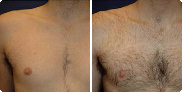 种植胸毛的效果 种胸毛怎么种 胸毛哪家能种植 新氧整形