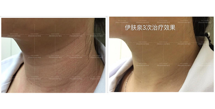 伊肤泉颈纹修护套组