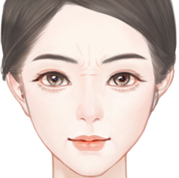 玻尿酸淡化鼻背纹