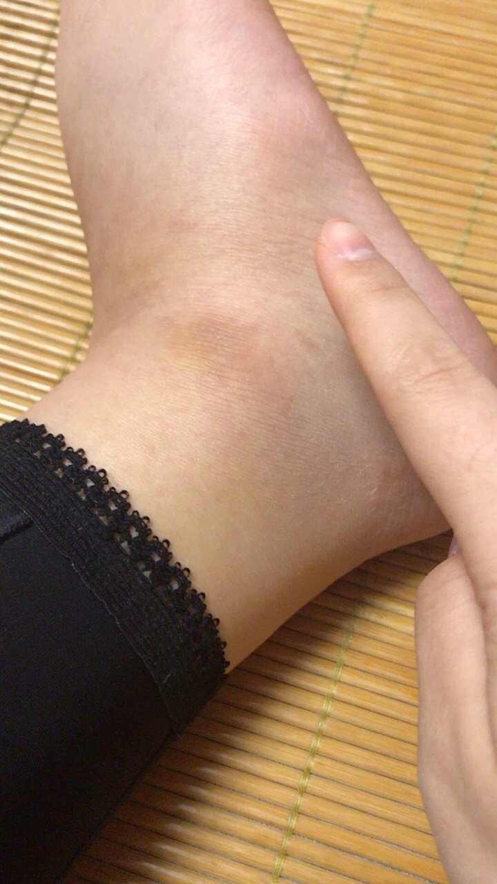 脚踝肿肿哒～一摁一个坑[:16]以前从来没有水肿过_圈子-新氧美容整形