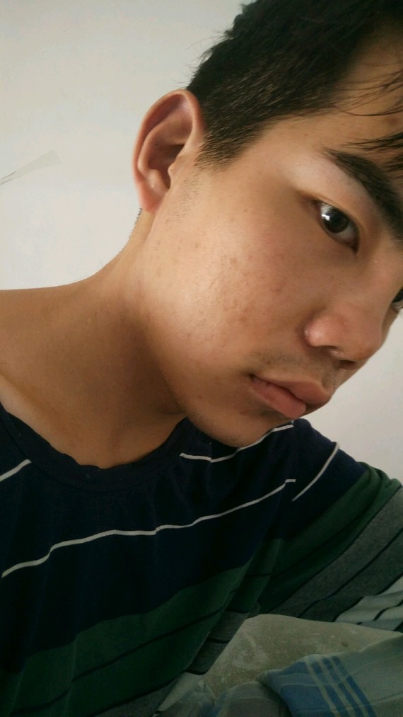 就算垫了下巴还是显嘴凸,我也想要那种瓜子脸.是不是要正颌手术?