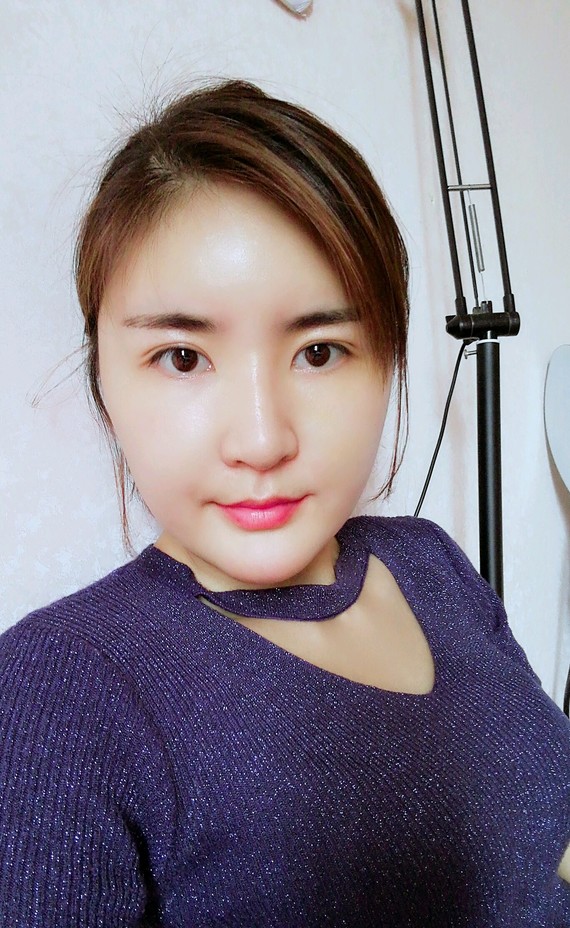 拥抱爱自体脂肪填充全脸第10天美丽日记-新氧美容整形