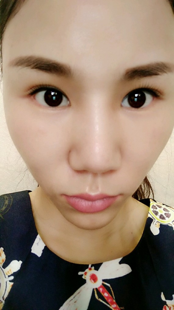 眼角 | 开外眼角 | 术后当自强 | 武汉同城 | 黄石同城 | 下眼下至术