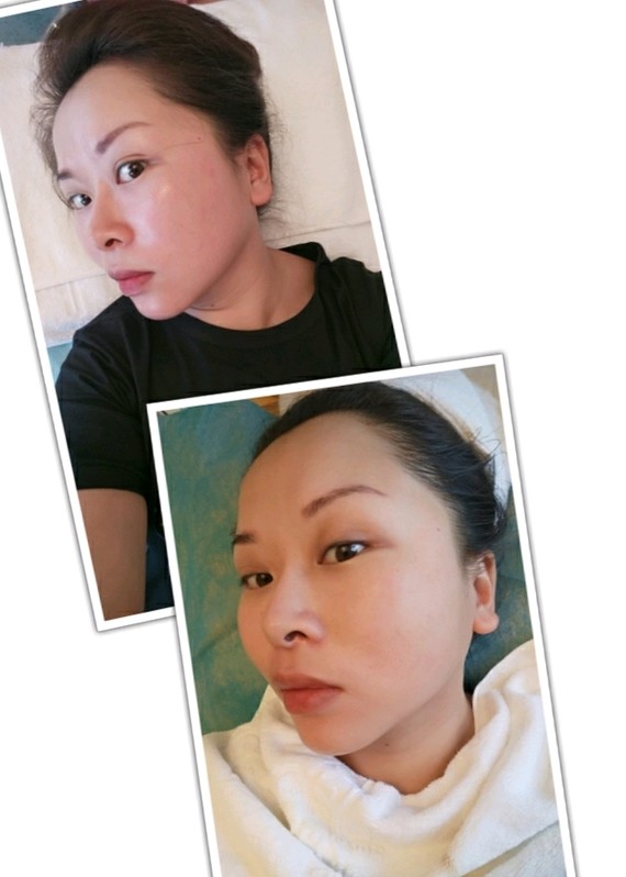 上面对比图更直观,明显脸部紧实了,轮廓更明显,颈部明显提升了
