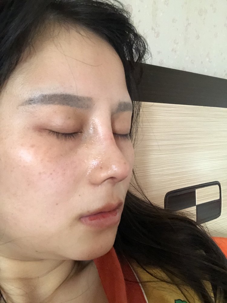 鼻根做太高了可以手术只把鼻根降下来吗,好烦做了