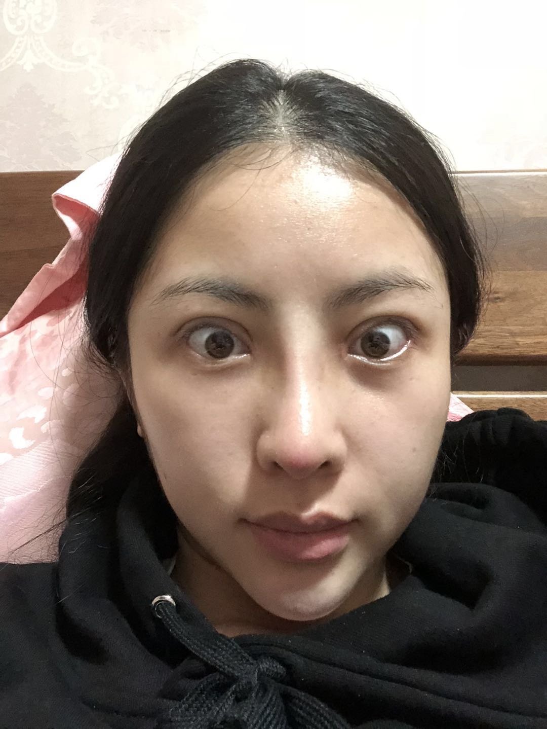 肋骨鼻部多项术后二十天 鼻头歪的 怎么办