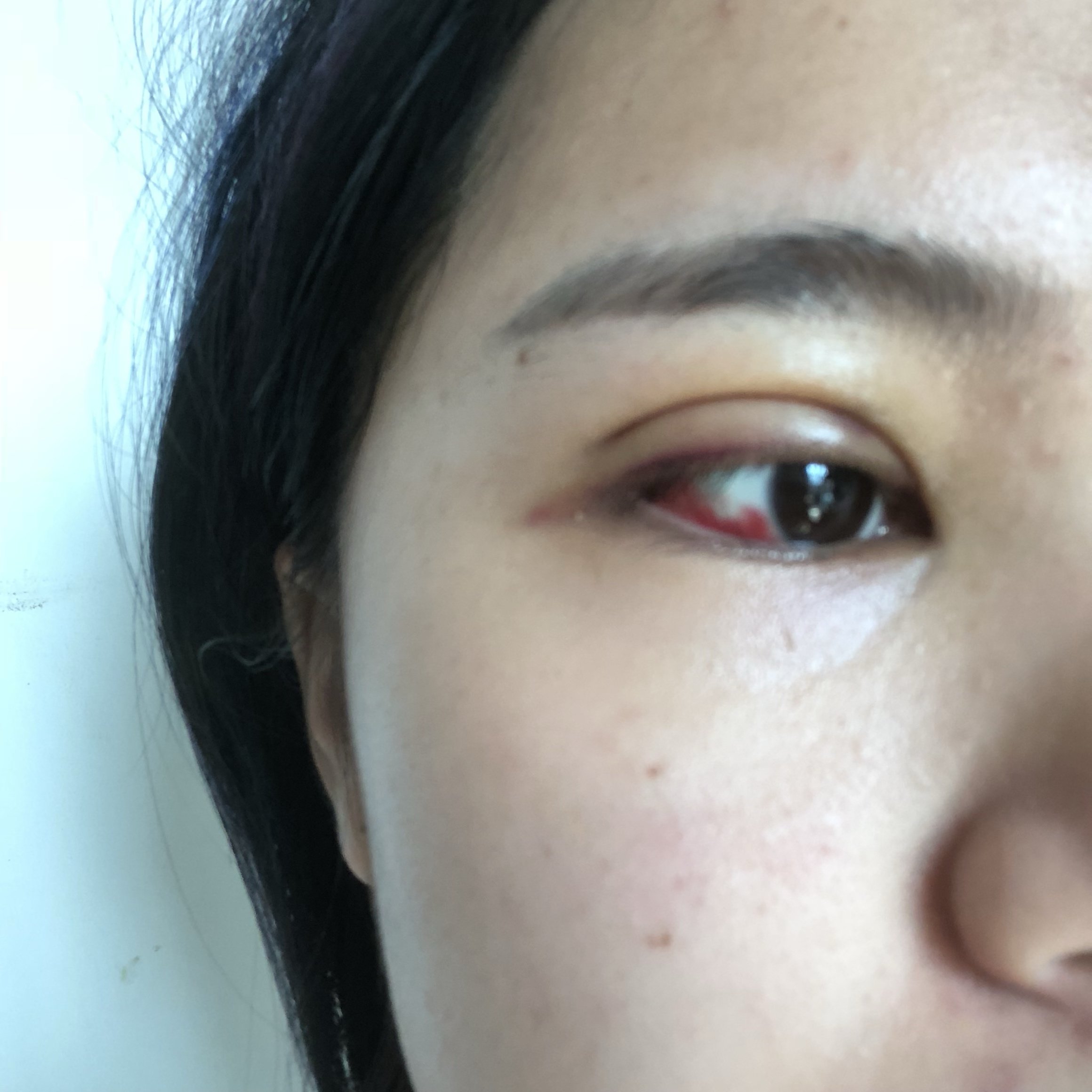 做完双眼皮第三天右眼充血比较严重有什么缓解的方法吗