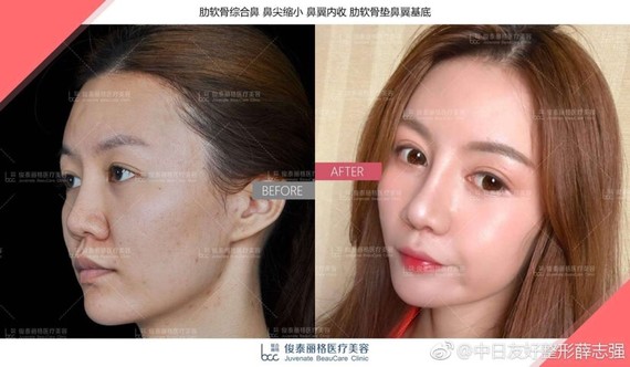 鼻翼沟深是因为鼻翼基底这个位置的上颌骨发育