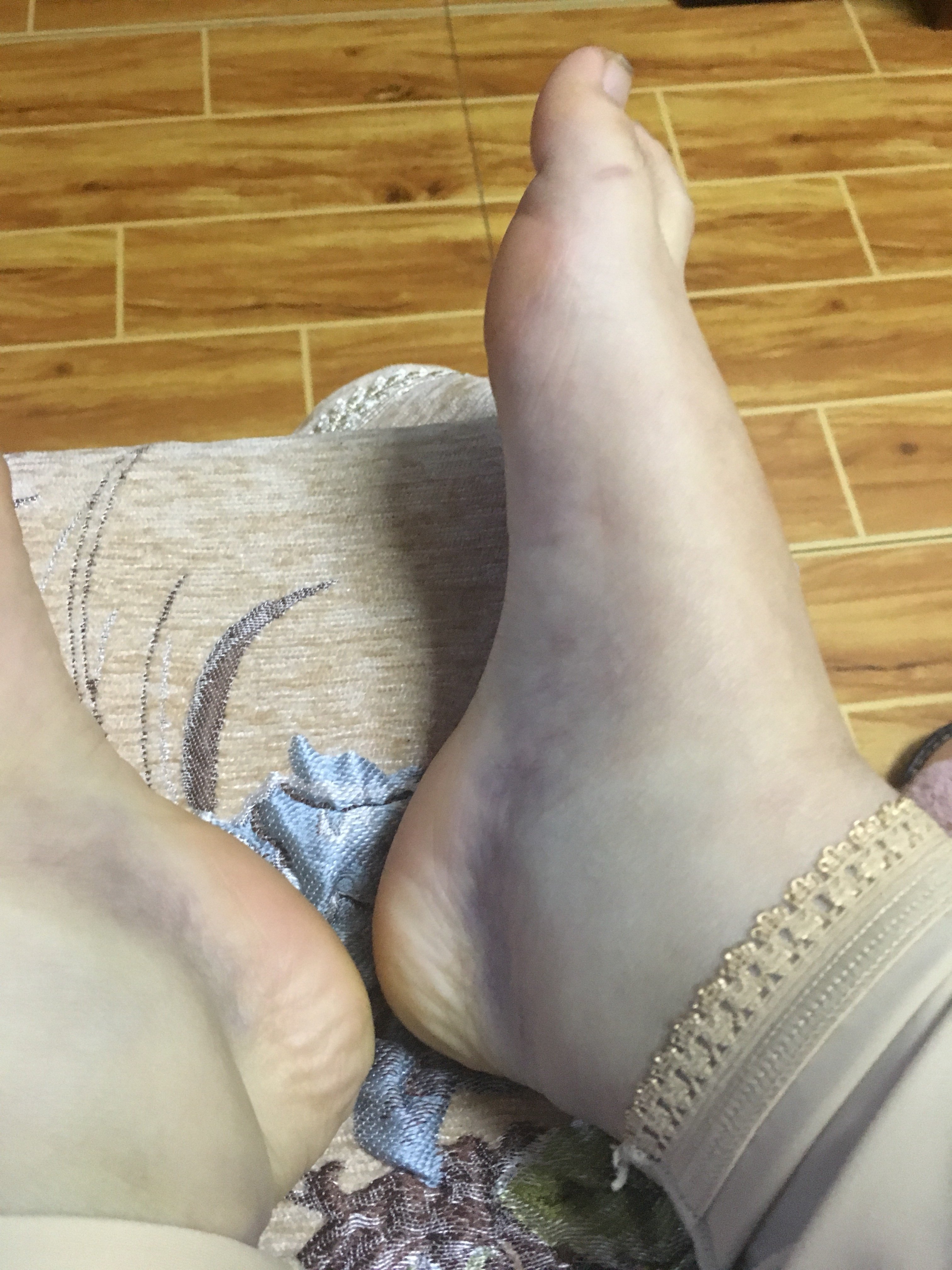 我已经做了吸脂手术 腿一天比一天肿是 新氧美容整形