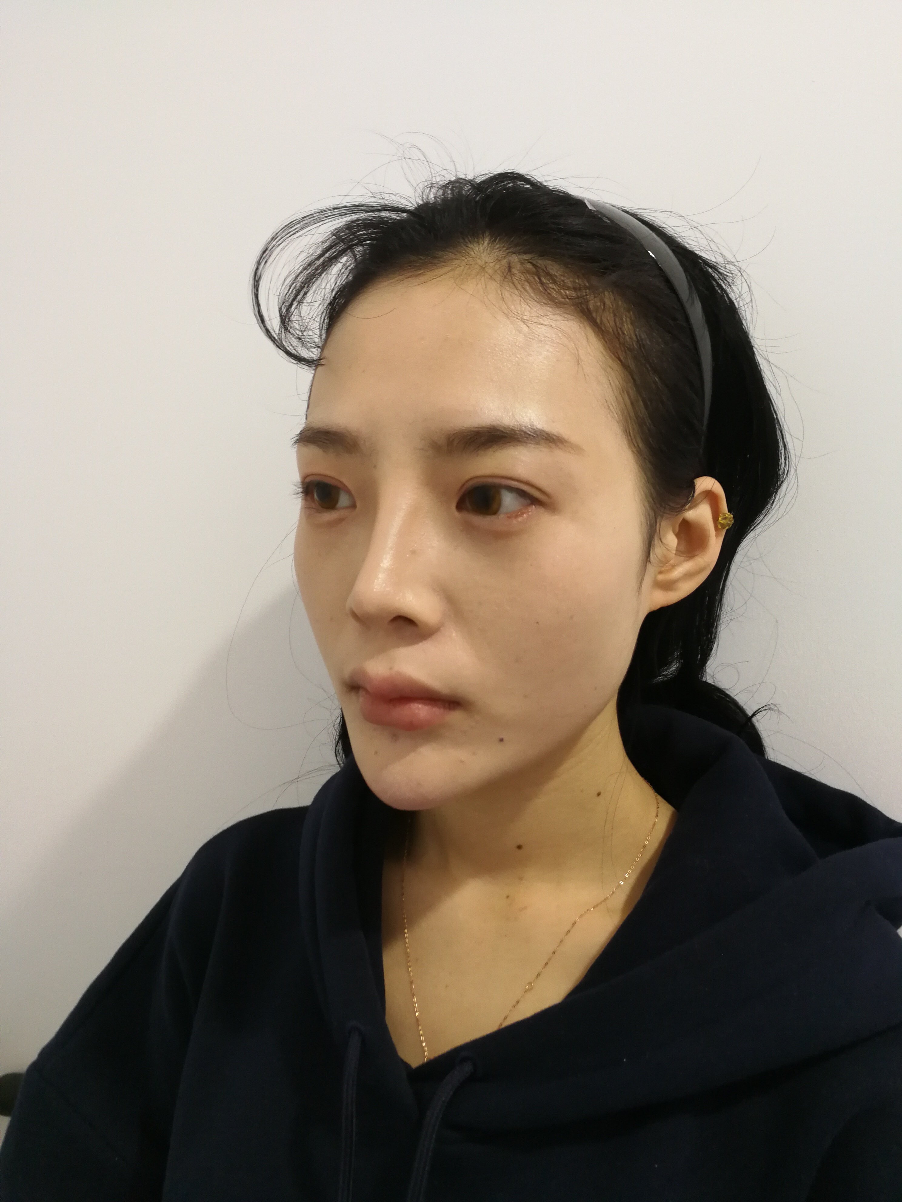 之前注射过玻尿酸隆鼻侧面看有一点不平而且通天是因为注射过量了吗