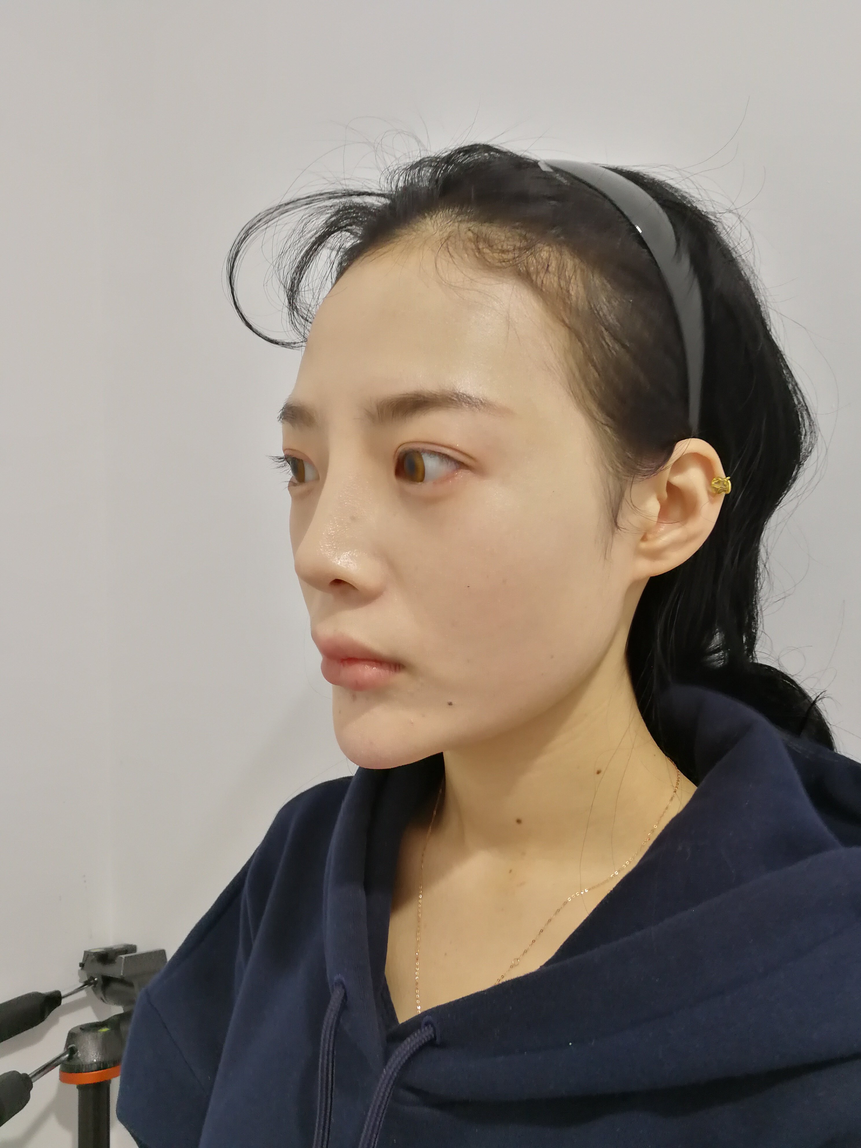 之前注射过玻尿酸隆鼻侧面看有一点不平而且通天是因为注射过量了吗