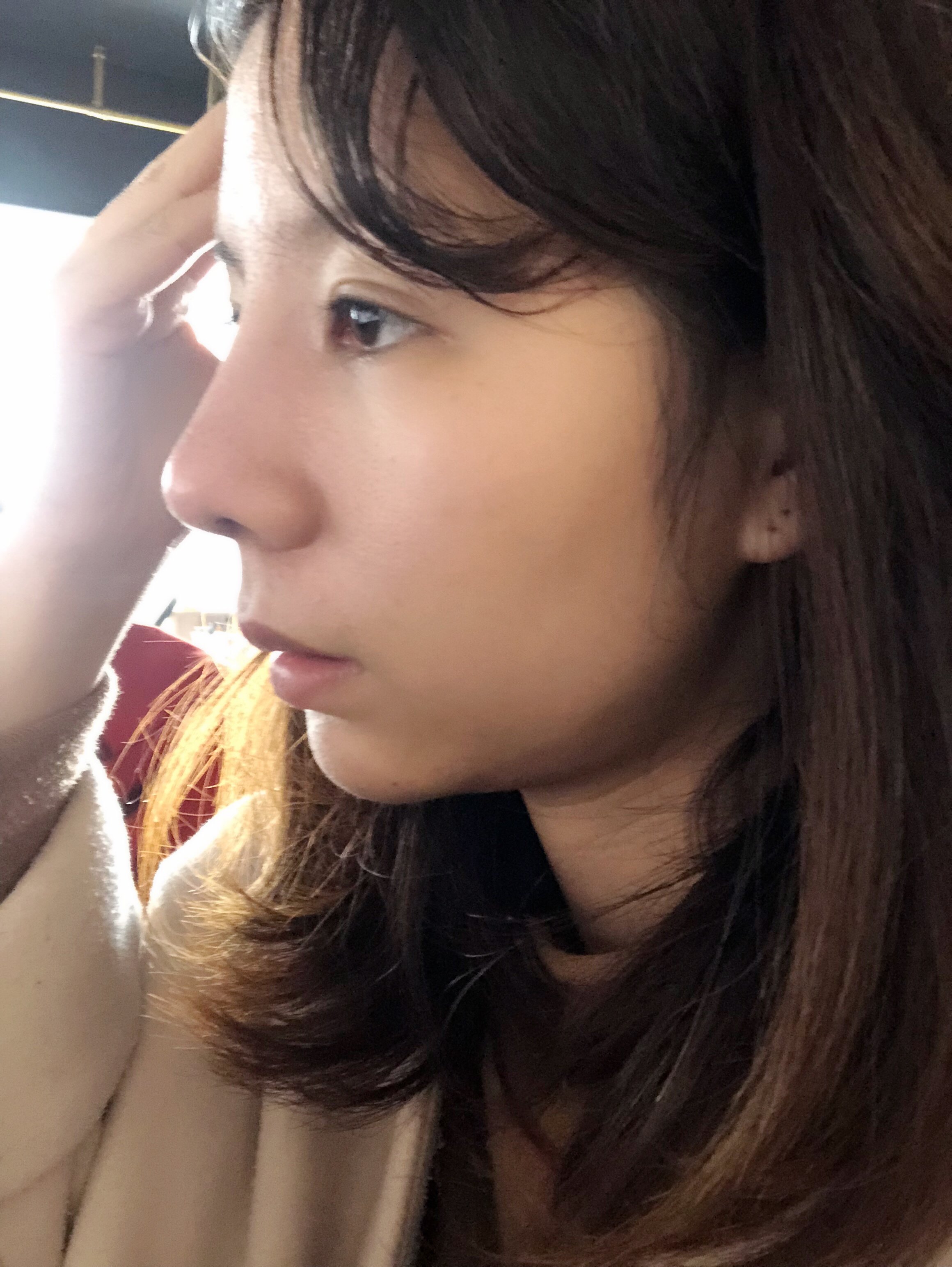 半肋 膨体隆鼻 做了26天了 感觉山根太高_新氧-专业医美服务平台