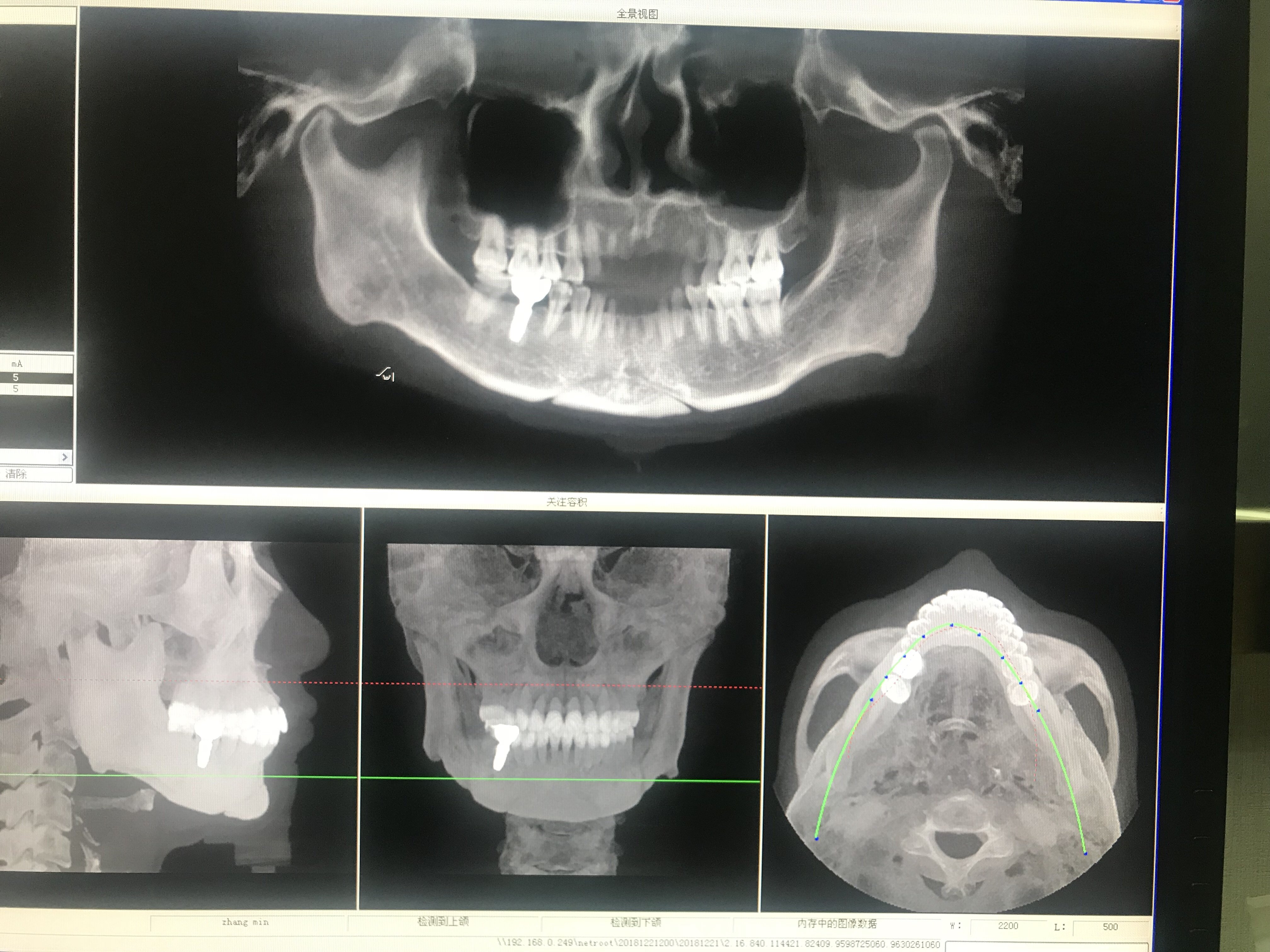 我这种脸型是颧骨不对称下颌角大小也不对称怎么做到好看的脸型