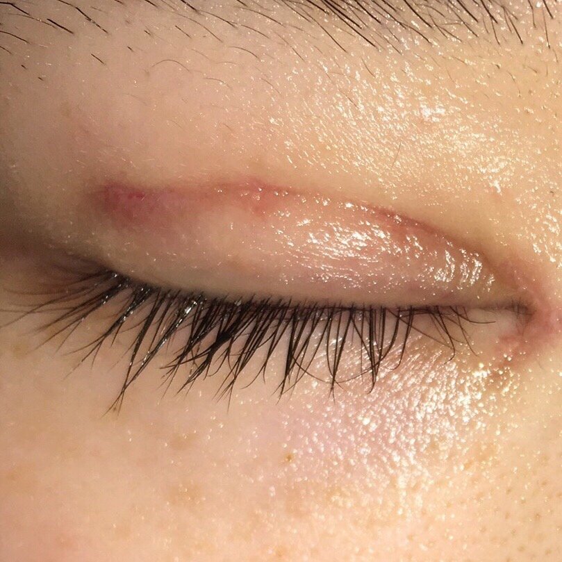 三点式双眼皮拆线第六天眼皮伤口很红个别伤口偏深色眼尾第三点与睫毛