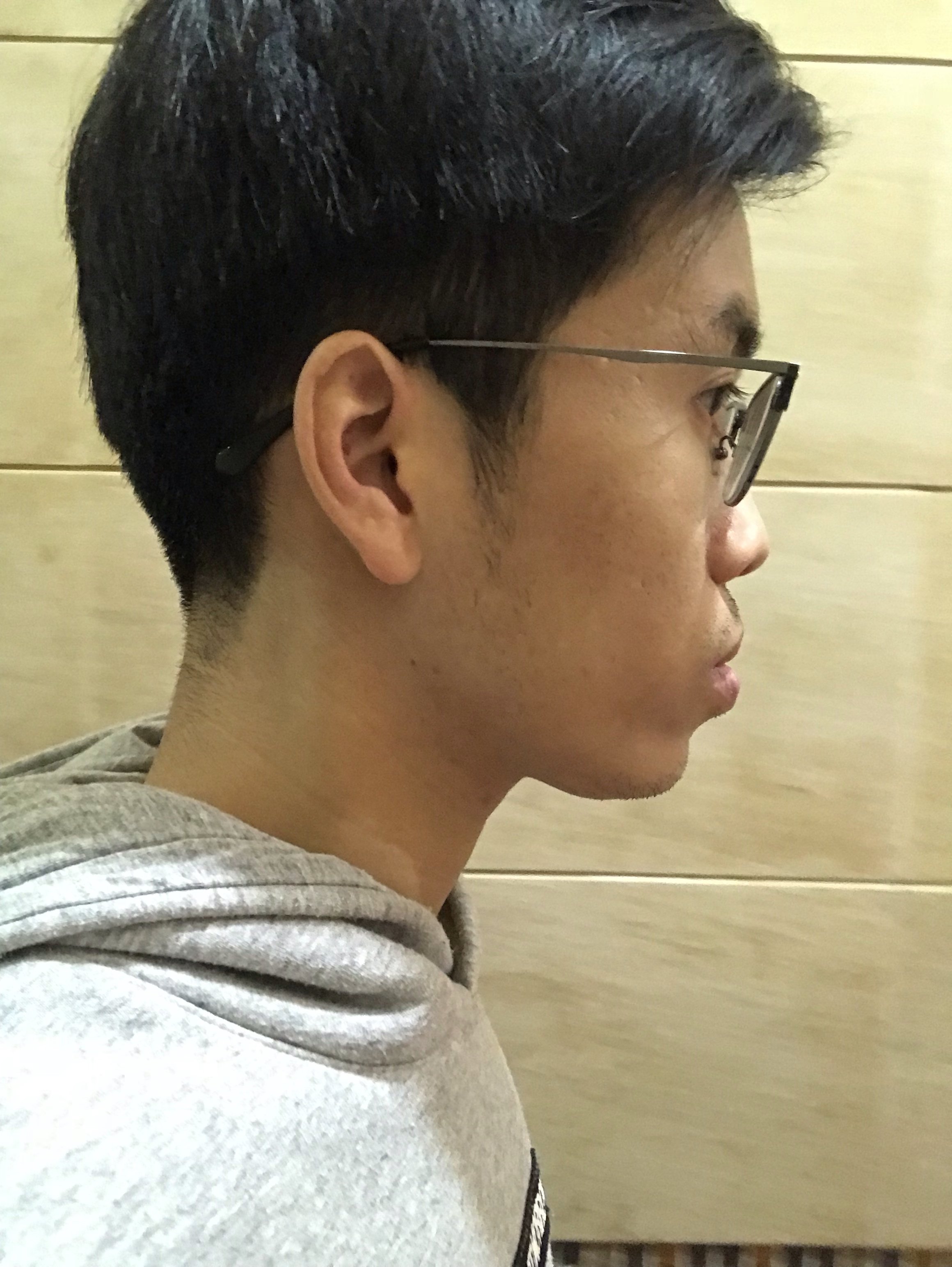 下巴的缘故导致下琶挥下巴没有下巴怎么办没有下巴的人下巴没有轮廓