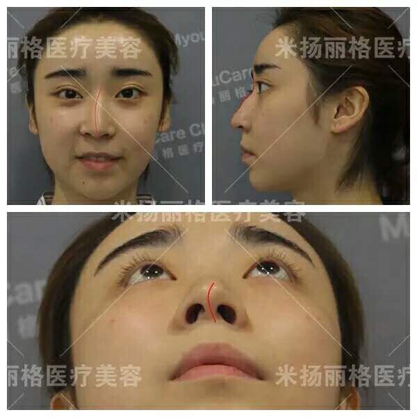 请问如果做鼻中隔偏曲矫正手术 鼻子会 新氧美容整形