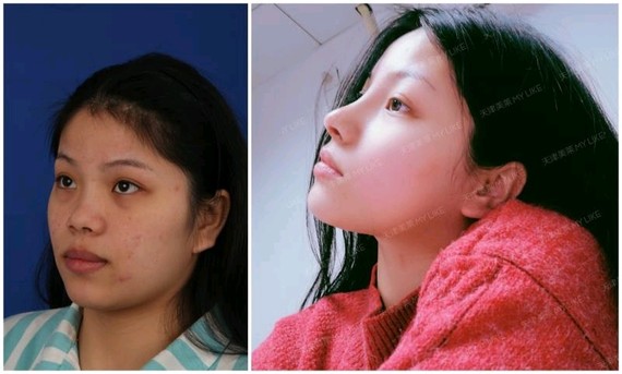 您好,隆鼻术后前几天伤口的肿胀现象会让鼻头显得特别大,有些人感觉术