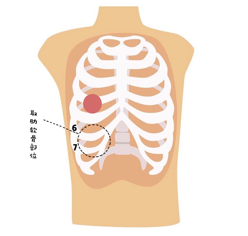 肋软骨隆鼻 一生只能取一次肋软骨吗 新氧美容整形