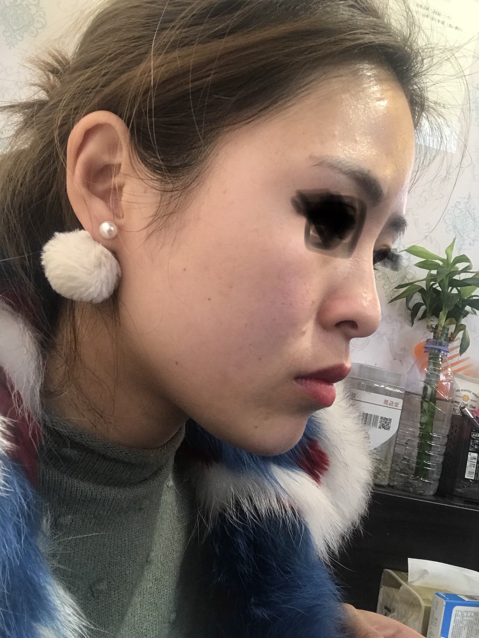 总觉的自己法令纹深,以前法令纹打过玻尿酸感觉没什么变化,我这种是