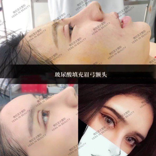 想丰眉弓 是膨体好 还是玻尿酸好 新氧美容整形