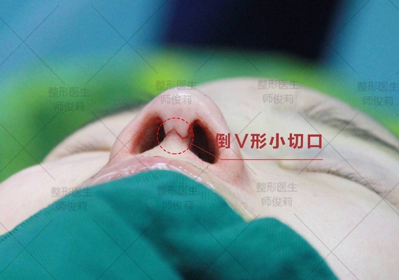 早期的鼻整形手术出现过鼻小柱的纵行切口,鼻小柱和鼻尖的v-y切口