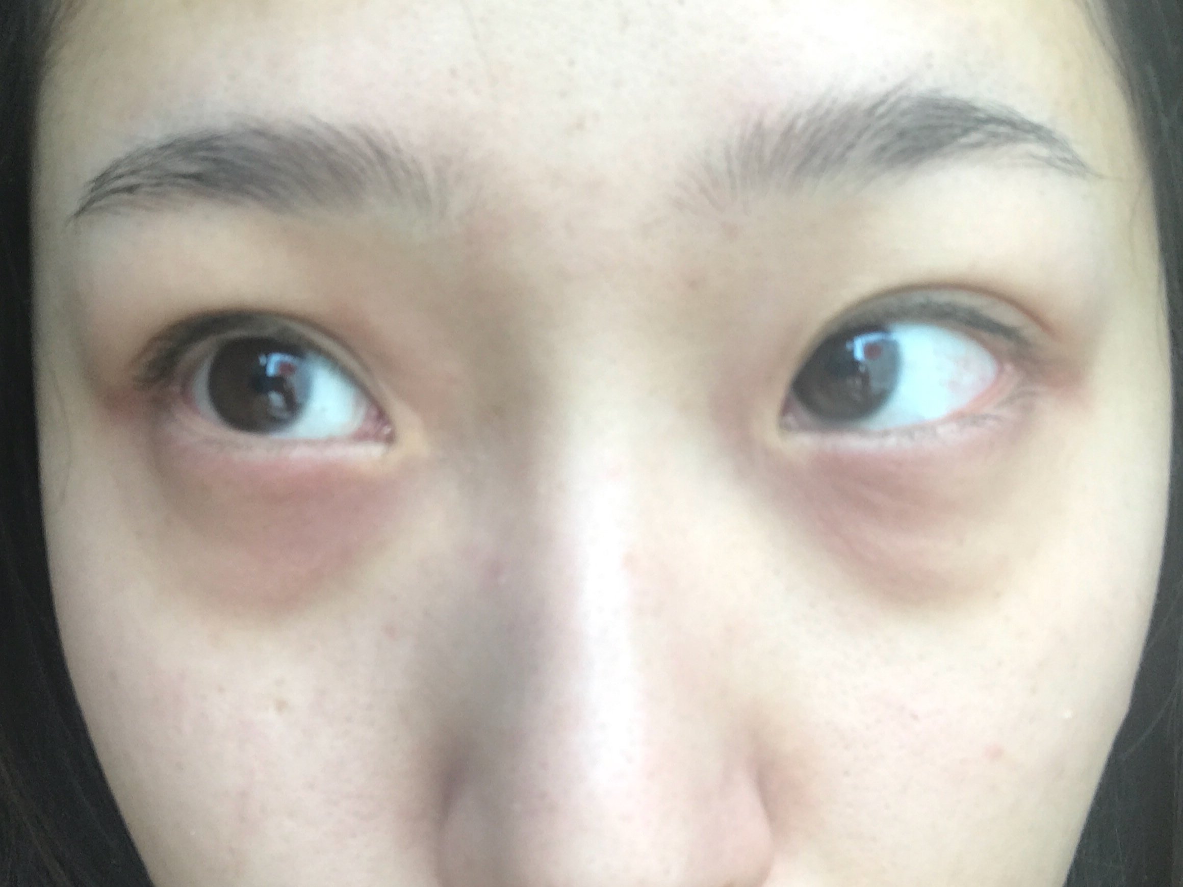 我22岁天生眼袋请问我眼袋下面是不是泪沟做去眼袋手术的话单纯内外切