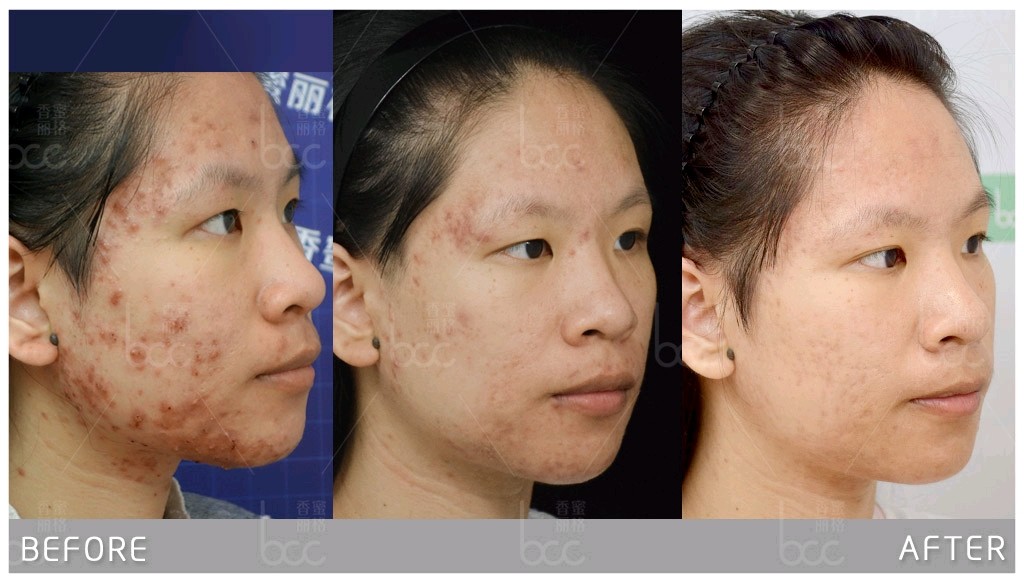 痘痘已经结痂了,可以自行处理么