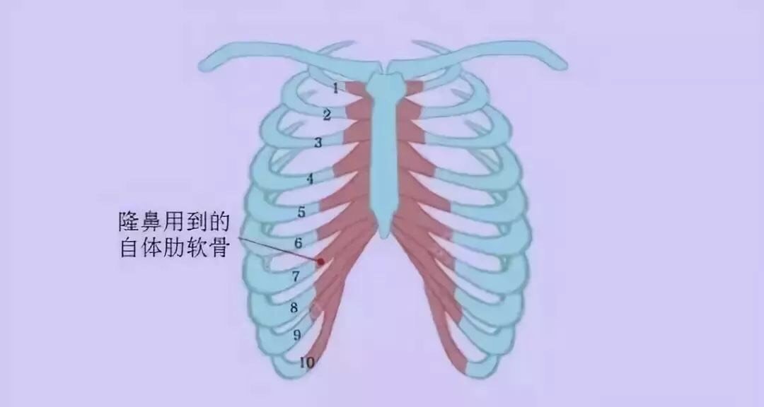 肋软骨取出有没有后遗症啊 新氧美容整形