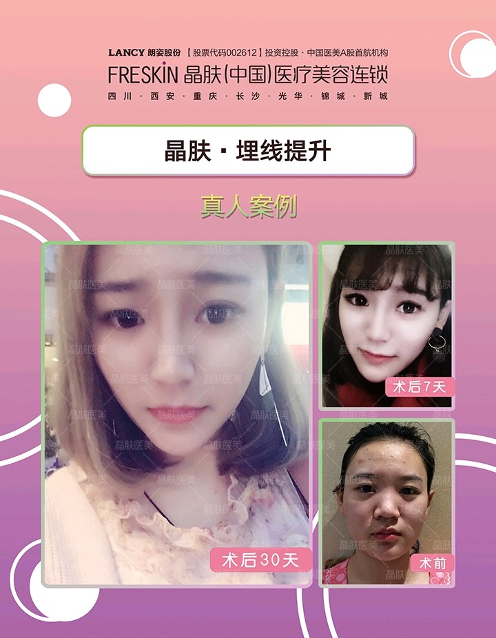 请问线雕后颧骨变高多久恢复 新氧 专业医美服务平台
