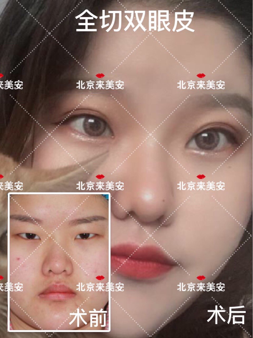 怎么可以让眼睛变大 但是保持单眼皮状 新氧美容整形