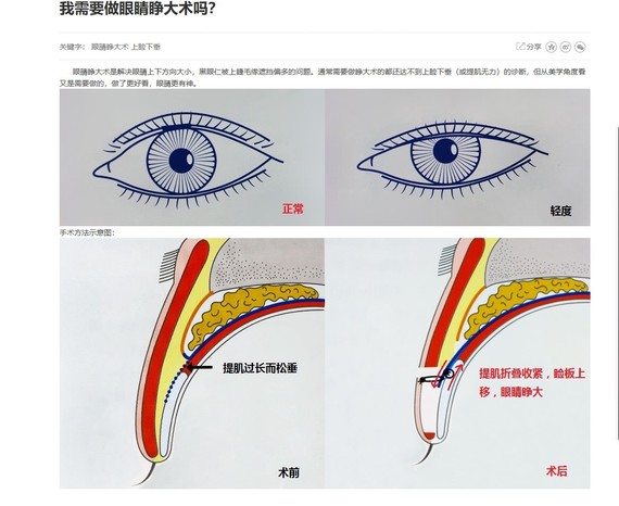 开内眼角原理图片