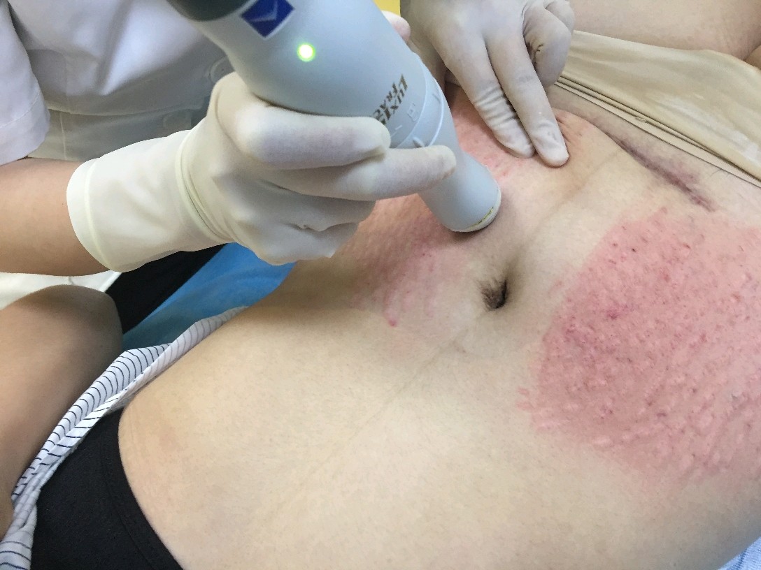 我们可以通过微针,帕洛玛(点阵激光)来治疗改善,妊娠纹的治疗最好在