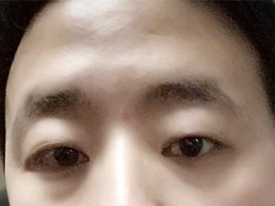 面部凹陷特别严重 尤其是额头部位 在 新氧美容整形 面部凹陷特别严重 尤其是额头部位 在 新氧美容整形