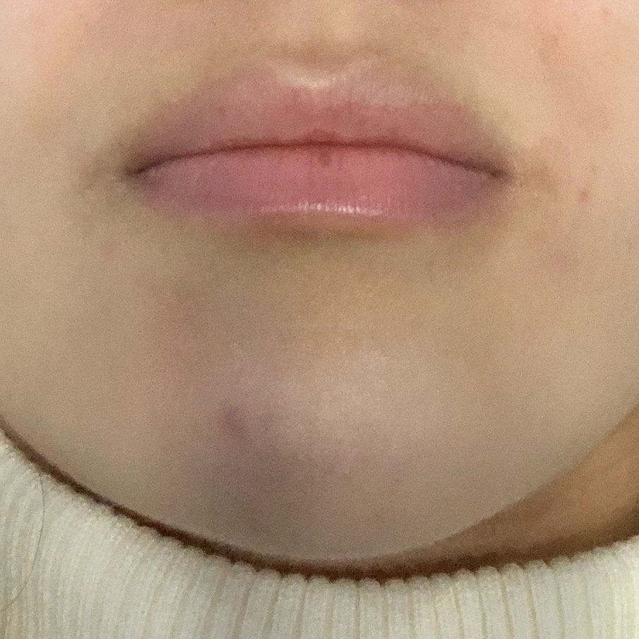 嘴角色素沉淀怎么解决啊,好烦啊?