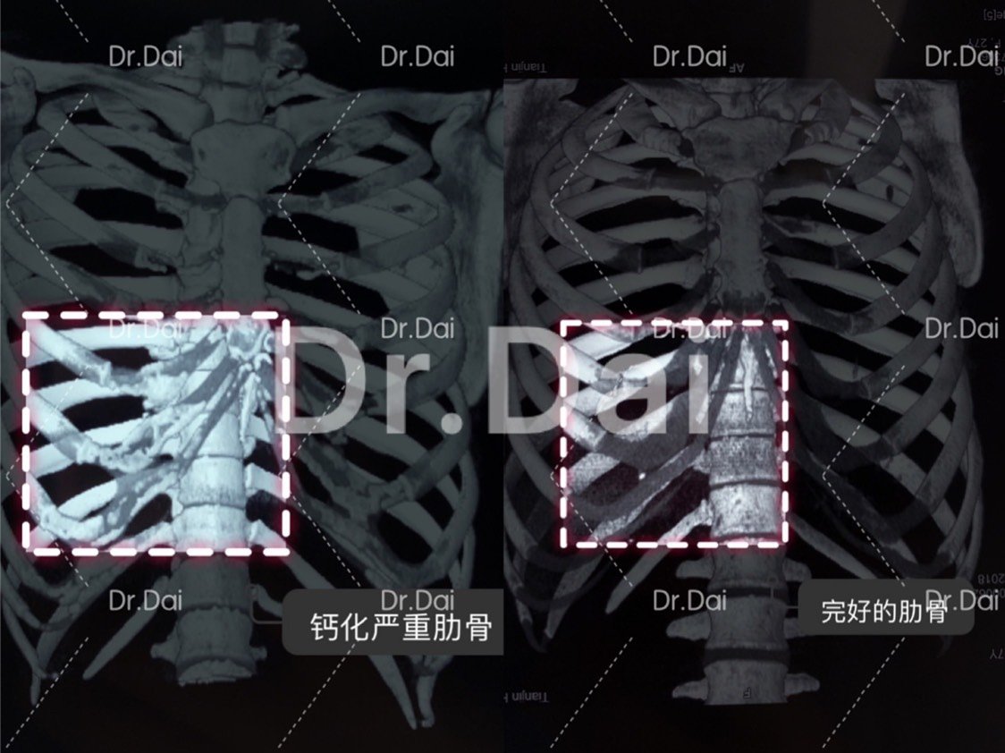 肋软骨钙化 是怎么回事 怎么知道肋软 新氧美容整形