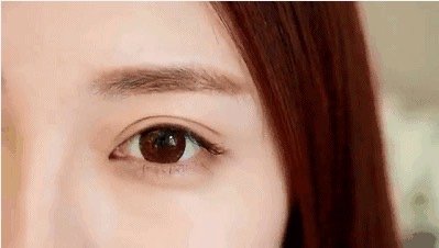 算是2次修复,不会改变形态,另外上眼睑脂肪厚