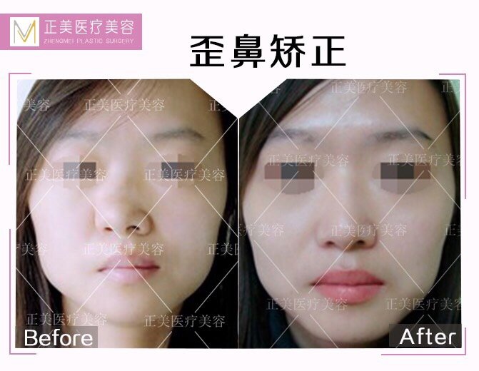鼻子明显是歪的 好像是骨头歪 这种整 新氧美容整形