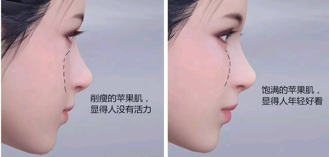 感觉自己的苹果肌有点下垂丰苹果肌玻尿酸好还是脂肪好