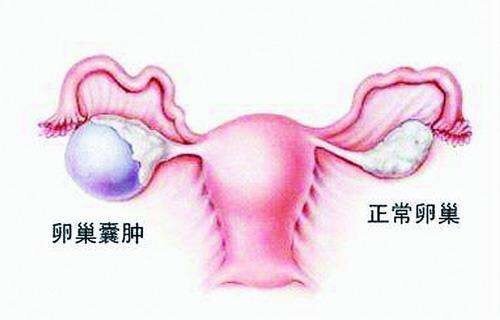 卵巢囊肿多大才可以切除