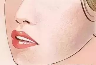 皮秒祛斑会反黑吗 新氧美容整形