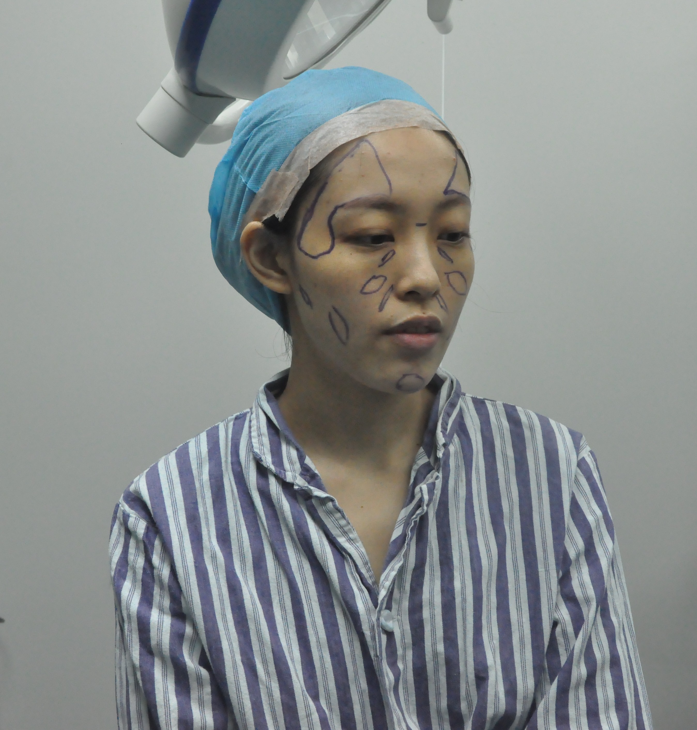 自体脂肪面部填充会显脸大吗?